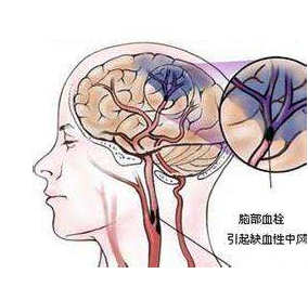 脑出血后遗症能治好吗？谨记6个事项减少后遗症